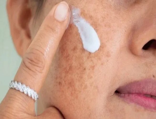 هشدار؛ مراقب سوختگی های پنهان آفتاب باشید