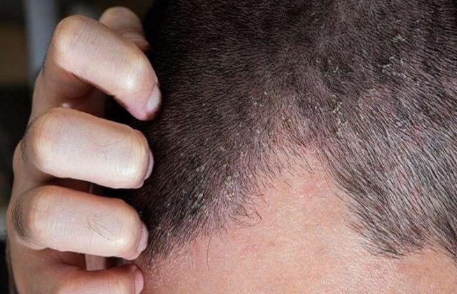 اگزمای پوست سر چیست و چطور درمان میشود؟