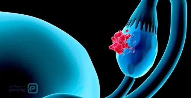 نفخ مداوم میتواند نشانهای از سرطان تخمدان باشد