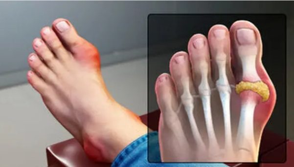 نقرس بیماری پولدارها نیست و همه گروه ها را درگیر می‌کند