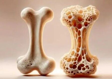 یک بیماری مهم که ۴۲ درصد زنان بالای ۶۰ سال و ۲۴ درصد آقایان بالای ۵۰ سال در ایران دچارش هستند