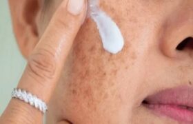 هشدار؛ مراقب سوختگی های پنهان آفتاب باشید