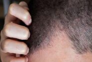 اگزمای پوست سر چیست و چطور درمان می‌شود؟
