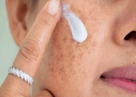 هشدار؛ مراقب سوختگی های پنهان آفتاب باشید