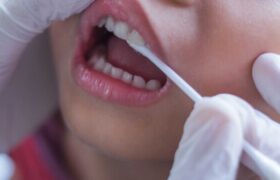 «فیشور سیلنت»؛ روشی مؤثر برای پیشگیری از پوسیدگی دندان کودکان