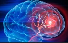 ۴ ساعت نخست؛ زمان طلایی نجات بیماران سکته مغزی