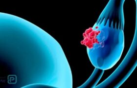 نفخ مداوم میتواند نشانهای از سرطان تخمدان باشد